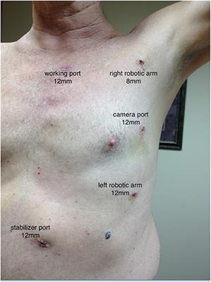 Transcatheter aortic valve replacement in patients undergoing robotic totally endoscopic coronary artery bypass: A case series